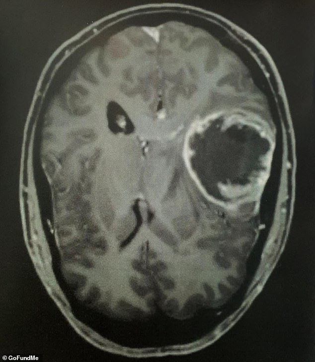 Sebuah tumor seukuran jeruk keprok (foto) terletak di dekat lobus temporal kanan Smith, dan ayah dua anak ini dijadwalkan untuk menjalani operasi darurat pada hari berikutnya.